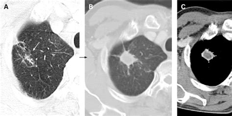 A Newly Developed Lung Nodule During Chemotherapy For Small Cell Lung