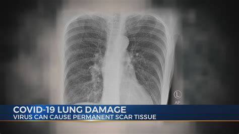 Permanent Lung Damage From Covid 19 Wttv Cbs4indy