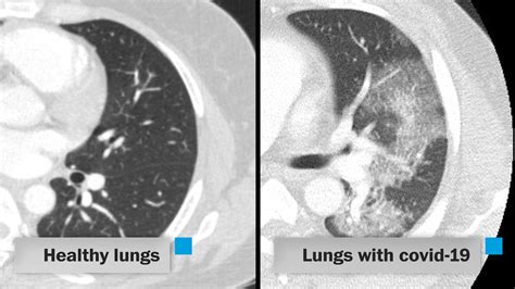 Understanding 10+ Lung Nodules After Covid19: Essential Insights