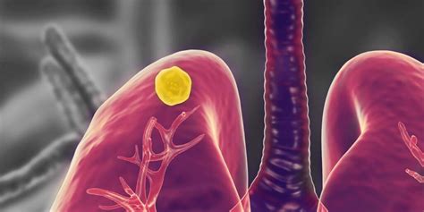 What Is A Lung Nodule American Health Imaging